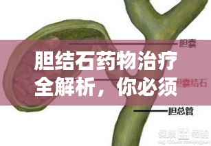 胆结石药物治疗全解析，你必须了解的知识
